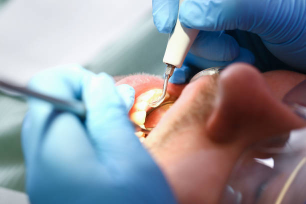 Best Emergency Gum Treatment in Fulton, NY